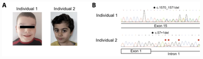 Integrated exome and transcriptome analysis prioritizes MAP4K4 de novo frameshift variants in autism spectrum disorder as a novel disease–gene association